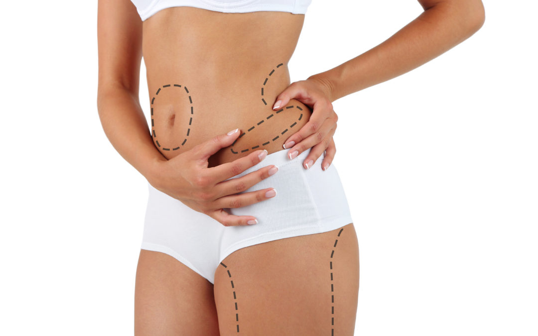 Liposuction ve uygulama alanları
