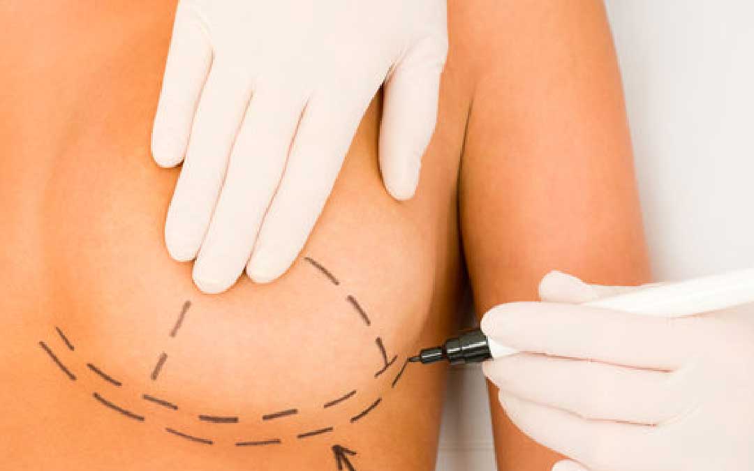 Will There Be Sagging Again After Breast Lift Surgery? » Op. Dr